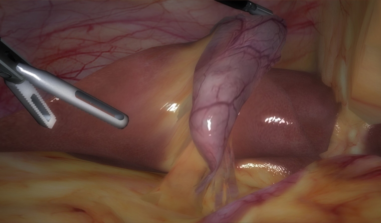 Full procedure of laparoscopic chole