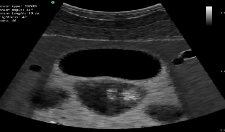 Urinary bladder (female anatomy) and female pelvis (uterus, ovaries) ultrasound scanning skills training module with abdominal transducer